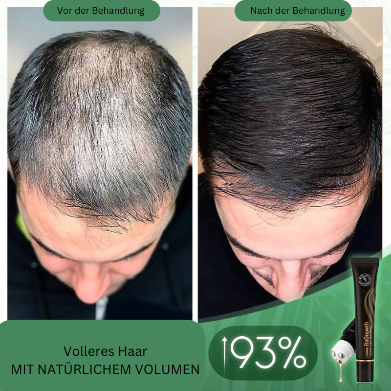 HairBoost™ Βιολογικός Ορός Μαλλιών σε Ρολό (Αγοράστε 1 Πάρτε 1 Δωρεάν)